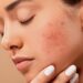 Consejos para quitar un grano de la cara