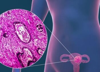 Inteligencia Artificial para tratar a pacientes con cáncer de endometrio