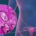 Inteligencia Artificial para tratar a pacientes con cáncer de endometrio