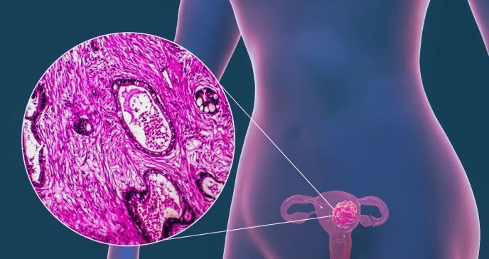 Inteligencia Artificial para tratar a pacientes con cáncer de endometrio